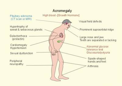 What is Acromegaly